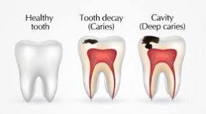 How to cure Dental Caries